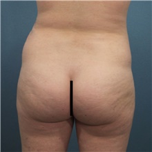 Buttock Lift with Augmentation Before Photo by Marvin Shienbaum, MD; Brandon, FL - Case 48600