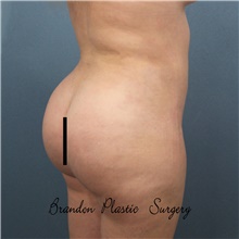 Buttock Lift with Augmentation After Photo by Marvin Shienbaum, MD; Brandon, FL - Case 48600