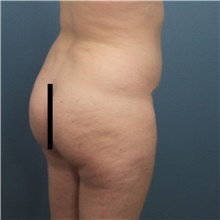 Buttock Lift with Augmentation Before Photo by Marvin Shienbaum, MD; Brandon, FL - Case 48600