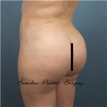 Buttock Lift with Augmentation After Photo by Marvin Shienbaum, MD; Brandon, FL - Case 48600