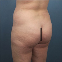 Buttock Lift with Augmentation Before Photo by Marvin Shienbaum, MD; Brandon, FL - Case 48600