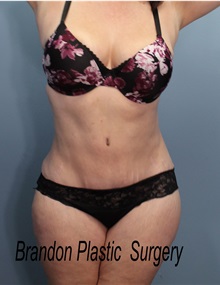 Tummy Tuck After Photo by Marvin Shienbaum, MD; Brandon, FL - Case 50512