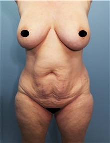 Tummy Tuck Before Photo by Marvin Shienbaum, MD; Brandon, FL - Case 50512