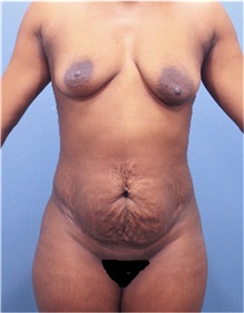 Mommy Makeover Before Photo by Marvin Shienbaum, MD; Brandon, FL - Case 51411