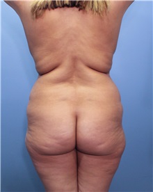 Body Contouring Before Photo by Marvin Shienbaum, MD; Brandon, FL - Case 49708