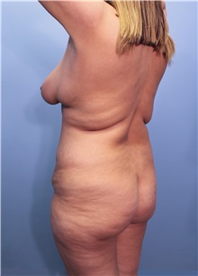 Body Contouring Before Photo by Marvin Shienbaum, MD; Brandon, FL - Case 49708
