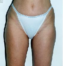 Liposuction After Photo by Luis Cenedese, MD; New York, NY - Case 4809