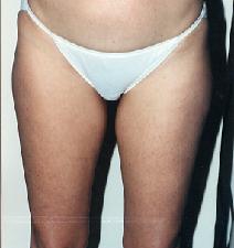 Liposuction Before Photo by Luis Cenedese, MD; New York, NY - Case 4809