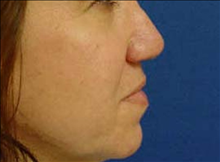 Rhinoplasty After Photo by Vincent Lepore, Jr.,  MD; San Jose, CA - Case 24022