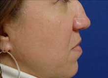 Rhinoplasty Before Photo by Vincent Lepore, Jr.,  MD; San Jose, CA - Case 24022