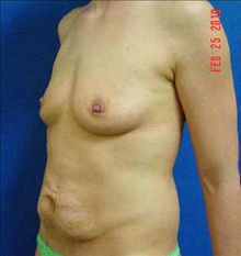 Breast Augmentation Before Photo by Vincent Lepore, Jr.,  MD; San Jose, CA - Case 24026