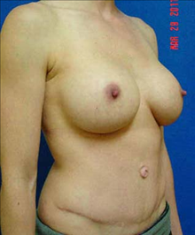 Breast Augmentation After Photo by Vincent Lepore, Jr.,  MD; San Jose, CA - Case 24026