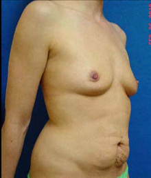 Breast Augmentation Before Photo by Vincent Lepore, Jr.,  MD; San Jose, CA - Case 24026
