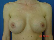 Breast Augmentation After Photo by Vincent Lepore, Jr.,  MD; San Jose, CA - Case 27484