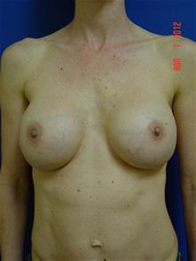 Breast Augmentation Before Photo by Vincent Lepore, Jr.,  MD; San Jose, CA - Case 27484