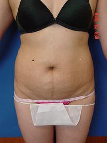 Tummy Tuck Before Photo by Vincent Lepore, Jr.,  MD; San Jose, CA - Case 27531