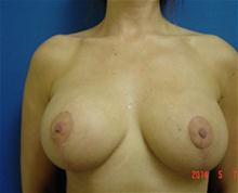 Breast Lift After Photo by Vincent Lepore, Jr.,  MD; San Jose, CA - Case 27716