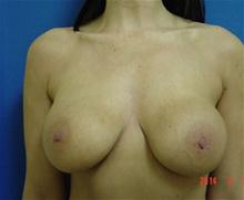 Breast Lift Before Photo by Vincent Lepore, Jr.,  MD; San Jose, CA - Case 27716