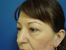 Eyelid Surgery Before Photo by Vincent Lepore, Jr.,  MD; San Jose, CA - Case 28034