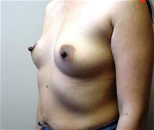Breast Augmentation Before Photo by Vincent Lepore, Jr.,  MD; San Jose, CA - Case 28088