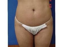 Liposuction After Photo by Vincent Lepore, Jr.,  MD; San Jose, CA - Case 28175