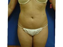 Liposuction Before Photo by Vincent Lepore, Jr.,  MD; San Jose, CA - Case 28175