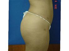 Liposuction After Photo by Vincent Lepore, Jr.,  MD; San Jose, CA - Case 28175
