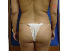 Liposuction Before Photo by Vincent Lepore, Jr.,  MD; San Jose, CA - Case 28175
