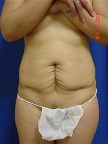 General Reconstruction Before Photo by Vincent Lepore, Jr.,  MD; San Jose, CA - Case 28774