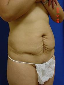 General Reconstruction Before Photo by Vincent Lepore, Jr.,  MD; San Jose, CA - Case 28774