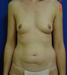 Breast Augmentation Before Photo by Vincent Lepore, Jr.,  MD; San Jose, CA - Case 28915