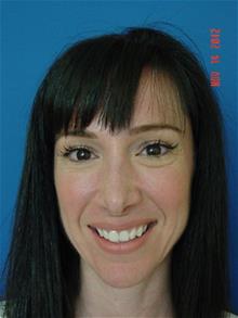 Rhinoplasty After Photo by Vincent Lepore, Jr.,  MD; San Jose, CA - Case 28977