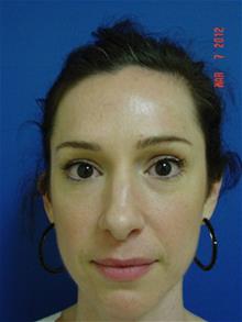 Rhinoplasty Before Photo by Vincent Lepore, Jr.,  MD; San Jose, CA - Case 28977