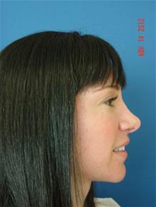 Rhinoplasty After Photo by Vincent Lepore, Jr.,  MD; San Jose, CA - Case 28977