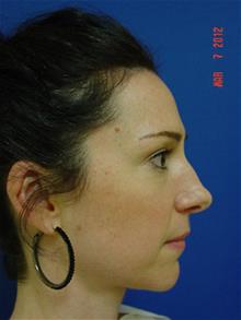 Rhinoplasty Before Photo by Vincent Lepore, Jr.,  MD; San Jose, CA - Case 28977