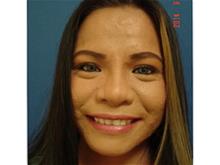 Rhinoplasty After Photo by Vincent Lepore, Jr.,  MD; San Jose, CA - Case 29308