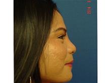 Rhinoplasty After Photo by Vincent Lepore, Jr.,  MD; San Jose, CA - Case 29308