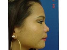 Rhinoplasty Before Photo by Vincent Lepore, Jr.,  MD; San Jose, CA - Case 29308