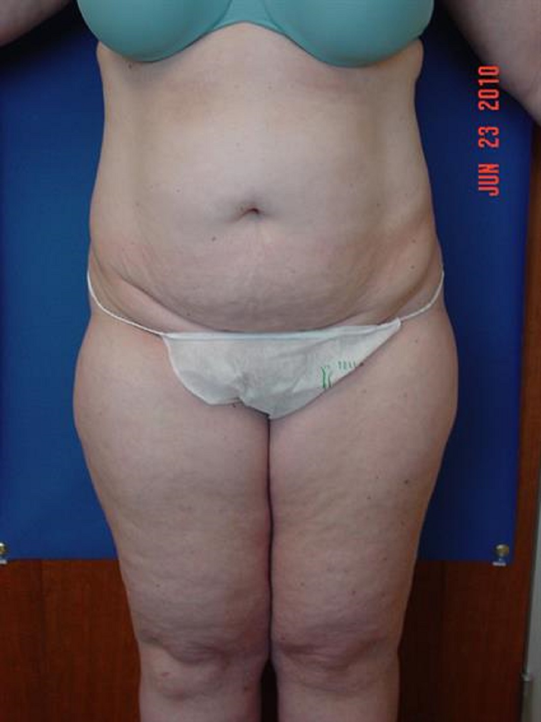 Tummy Tuck, San Jose CA