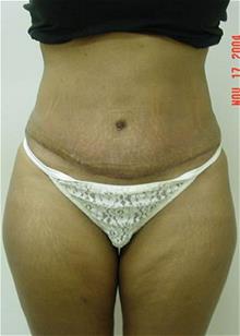 Liposuction After Photo by Vincent Lepore, Jr., MD; San Jose, CA - Case 29704