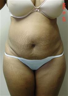 Liposuction Before Photo by Vincent Lepore, Jr., MD; San Jose, CA - Case 29704