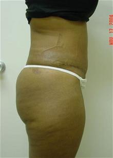 Liposuction After Photo by Vincent Lepore, Jr., MD; San Jose, CA - Case 29704