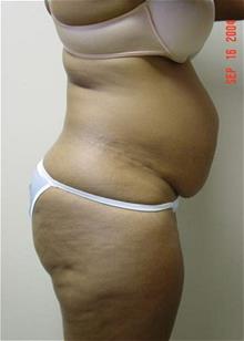 Liposuction Before Photo by Vincent Lepore, Jr., MD; San Jose, CA - Case 29704