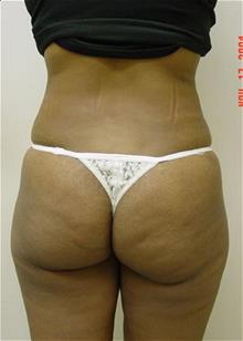 Liposuction After Photo by Vincent Lepore, Jr., MD; San Jose, CA - Case 29704