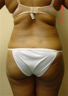 Liposuction Before Photo by Vincent Lepore, Jr., MD; San Jose, CA - Case 29704