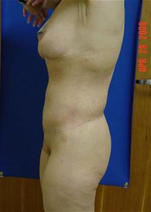 Liposuction After Photo by Vincent Lepore, Jr.,  MD; San Jose, CA - Case 29706