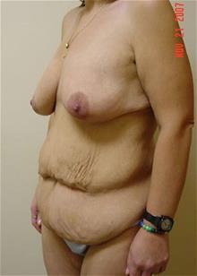 Liposuction Before Photo by Vincent Lepore, Jr.,  MD; San Jose, CA - Case 29706