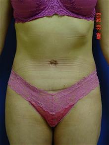 Liposuction After Photo by Vincent Lepore, Jr., MD; San Jose, CA - Case 29709