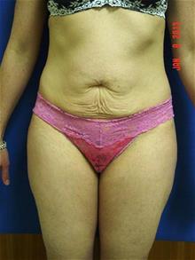 Liposuction Before Photo by Vincent Lepore, Jr., MD; San Jose, CA - Case 29709