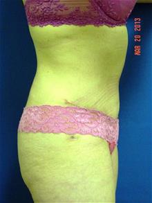 Liposuction After Photo by Vincent Lepore, Jr., MD; San Jose, CA - Case 29709